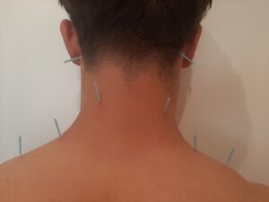 Akupunktur bei Nackenvespannungen