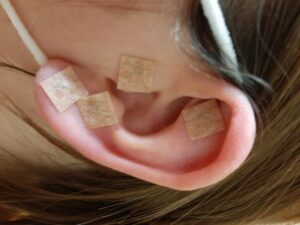 Ohr-Akupunktur mit Dauernadeln zur Gewichtsreduktion