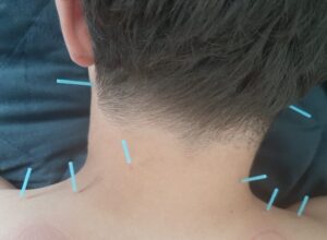 Akupunktur bei Nackenverspannungen