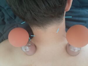 Akupunktur in Kombination mit Schröpfköpfen bei Nackenverspannungen